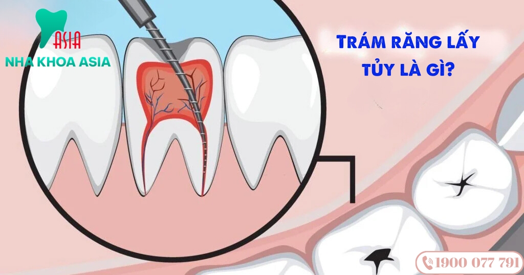 Trám răng lấy tủy là phương pháp phục hồi răng sau khi điều trị viêm tủy