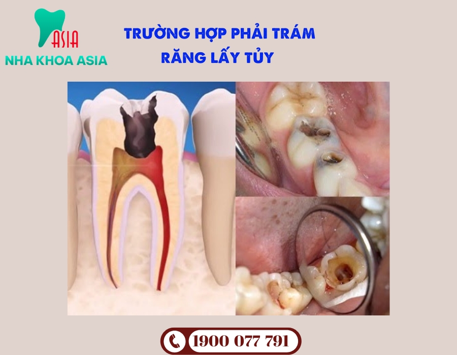 Nên trám răng lấy tủy khi răng đau nhức do viêm hoặc sâu nặn