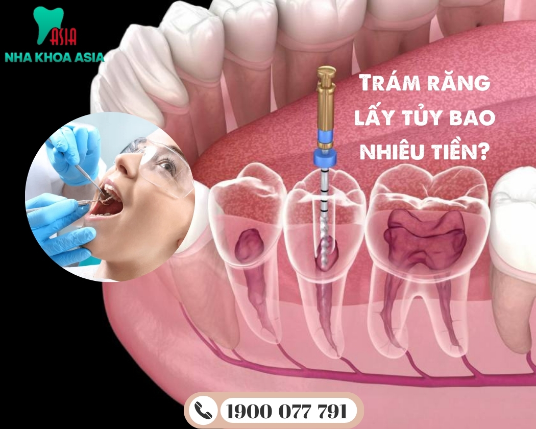 Trám răng lấy tủy bao nhiêu tiền phụ thuộc vào tình trạng răng và loại vật liệu trám
