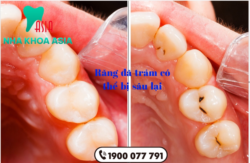 Răng đã trám vẫn có thể bị sâu lại nếu không chăm sóc đúng cách