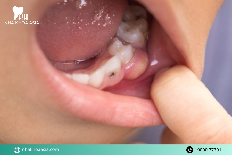 Áp xe răng ở trẻ em là gì? Áp xe răng ở trẻ có nguy hiểm không?