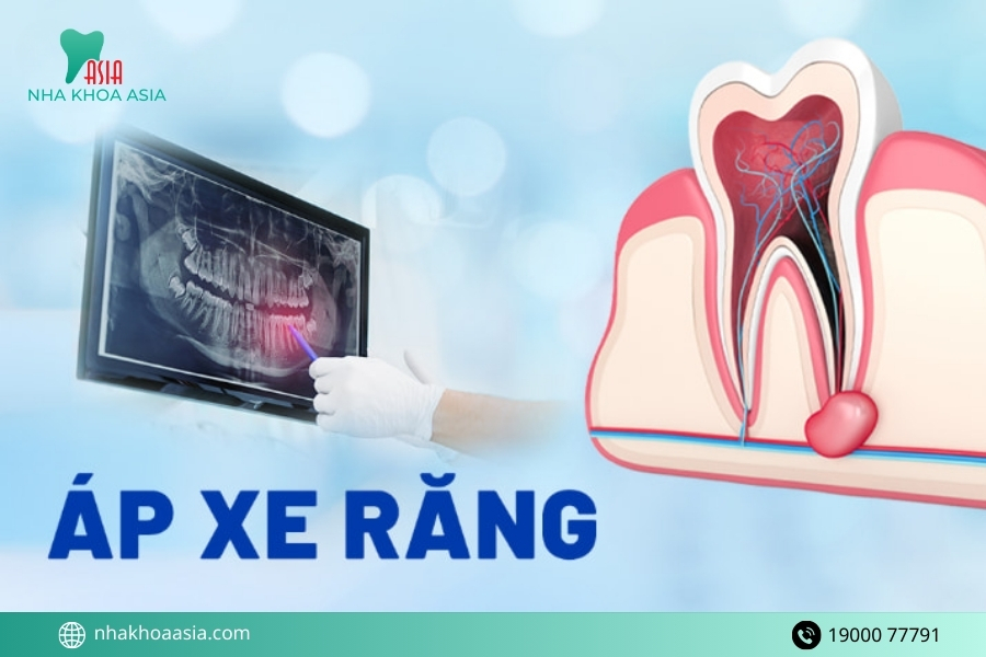 Trẻ bị áp xe răng phải làm sao?