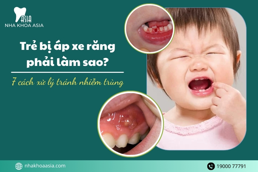Trẻ bị áp xe răng phải làm sao? 7 cách xử lý tránh nhiễm trùng