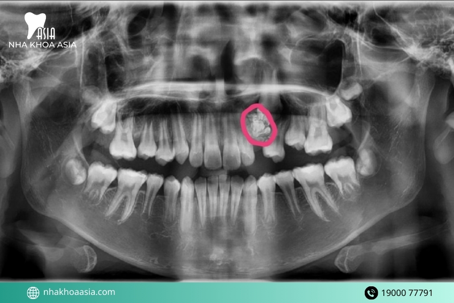 Trẻ bị áp xe răng phải làm sao?
