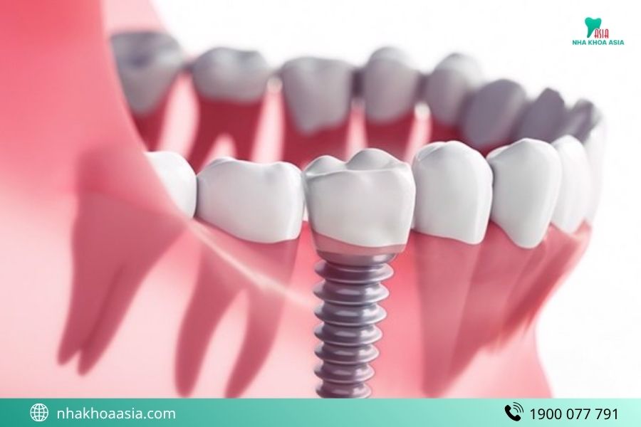 Trồng răng Implant có vĩnh viễn không