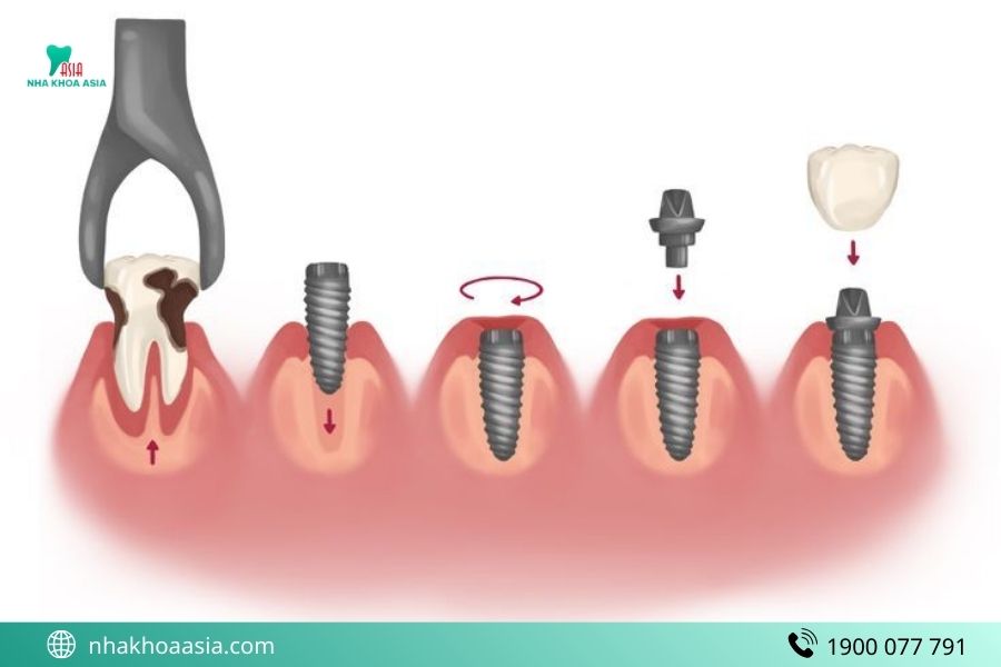 Địa chỉ trồng Implant uy tín TP.HCM