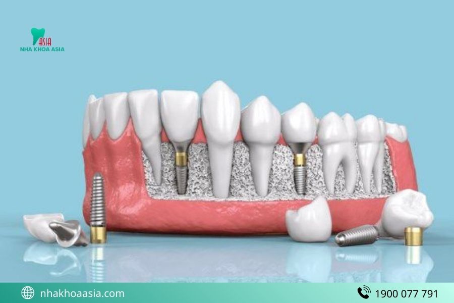 Trồng Implant rồi có chụp MRI được khong?