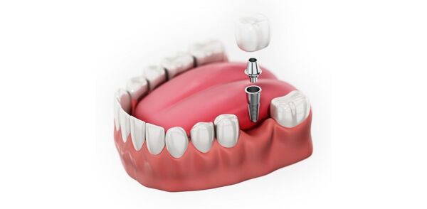 Nên áp dụng phương pháp nào khi trồng răng cấm