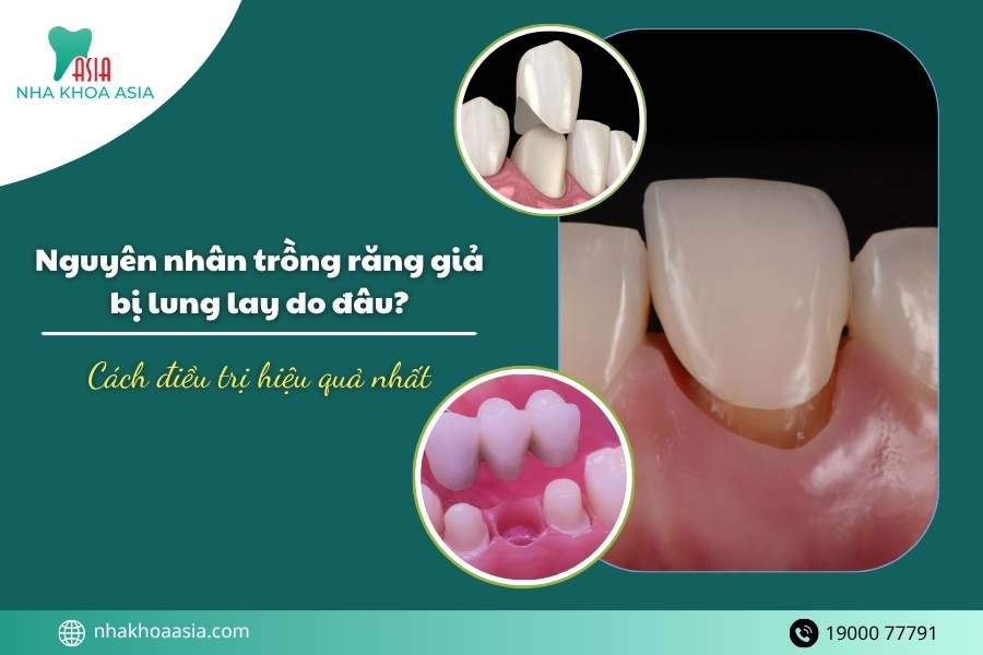 Nguyên nhân trồng răng giả bị lung lay do đâu? Cách điều trị hiệu quả nhất
