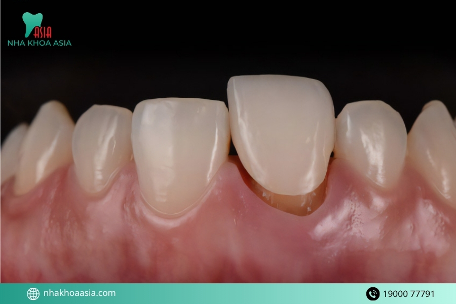Trồng răng giả bị lung lay là gì? Dấu hiệu nhận biết sớm nhất