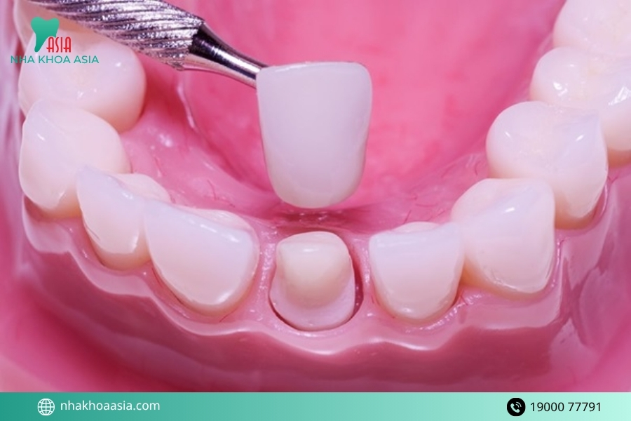Phương pháp điều trị trồng răng giả bị lung lay hiệu quả