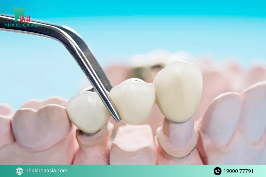 Quy trình rồng răng implant chuẩn nha khoa gồm những bước nào? 