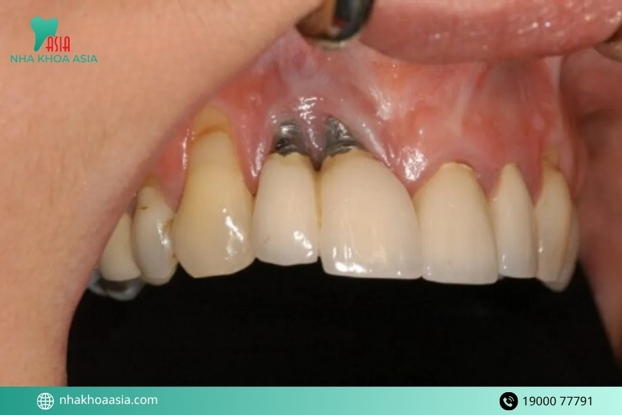 Cách phòng ngừa trồng răng implant bị lung lay hiệu quả