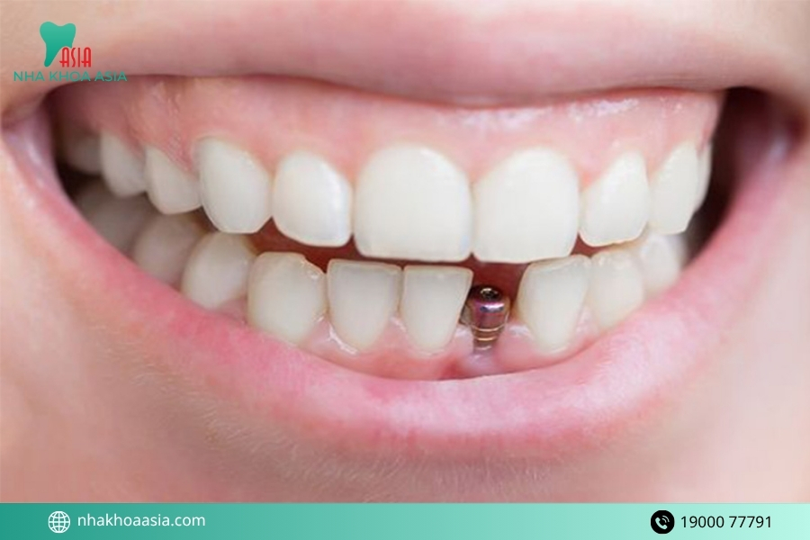 Chuyên gia mách bạn cách chăm sóc để kéo dài tuổi thọ răng sứ implant