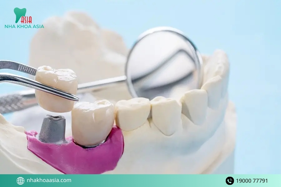 Phương pháp điều trị trồng răng giả bị lung lay hiệu quả