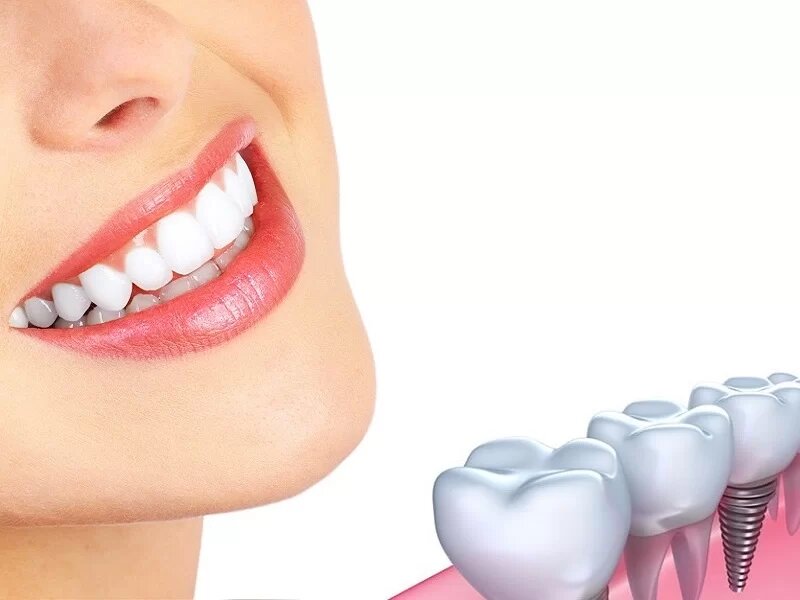 Lợi ích của việc khi trồng răng implant