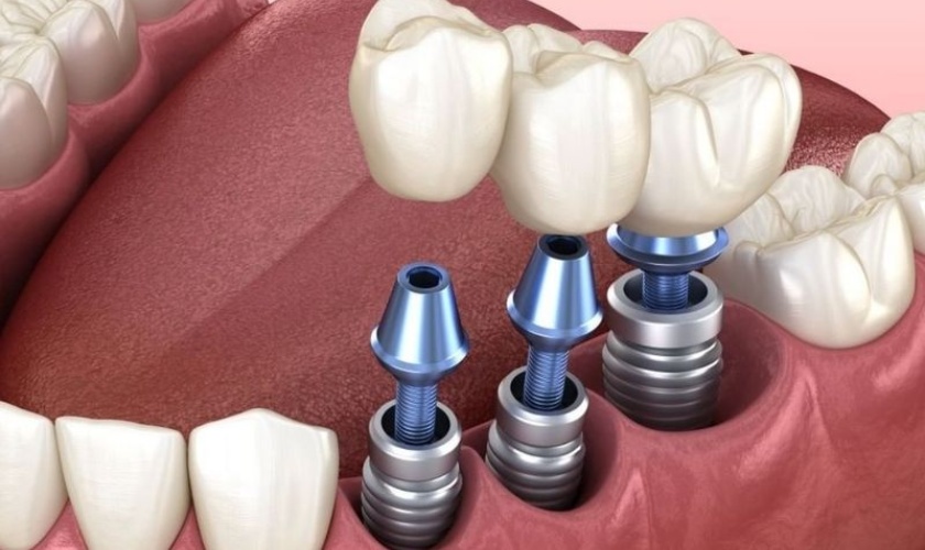 Ưu nhược điểm của trồng răng implant