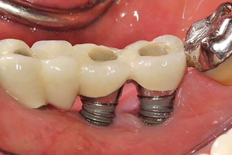 Trụ implant bị đào thải sau khi trồng răng implant