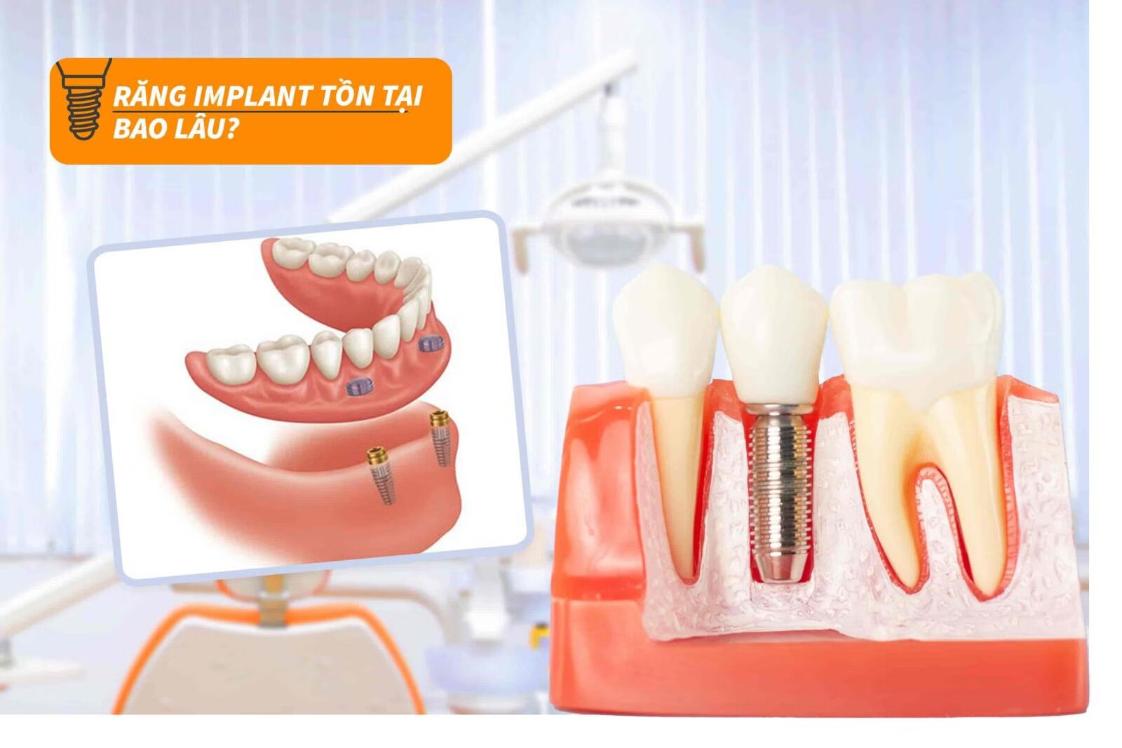 Ưu nhược điểm của trồng răng implant
