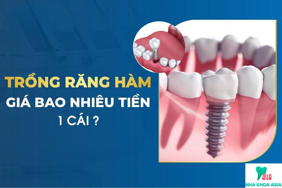 Trồng răng implant gia bao nhiêu 1 cái