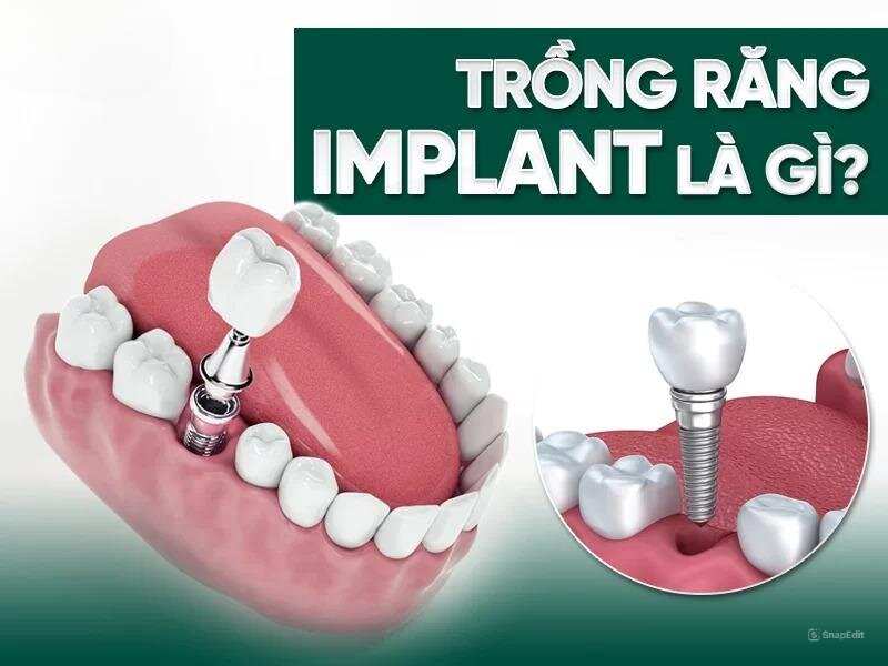 Trồng răng implant là gì?