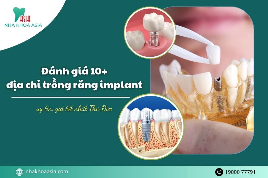 Đánh giá 10+ địa chỉ trồng răng implant Thủ Đức (Quận 2, Quận 9, Thủ Đức)