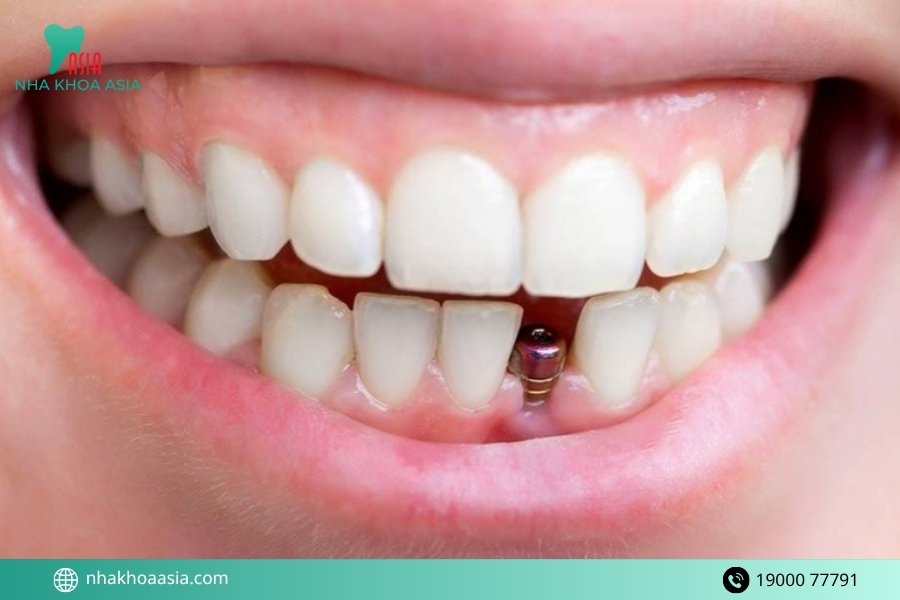 Phương pháp trồng răng Implant là gì?