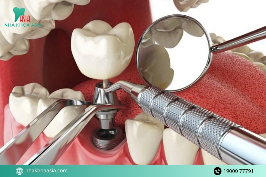 Tại sao nên lựa chọn phương pháp trồng răng Implant?