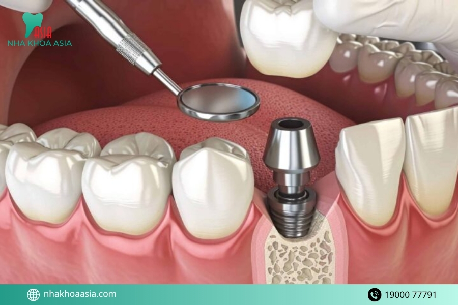 Tại sao nên lựa chọn phương pháp trồng răng Implant?