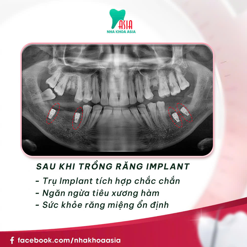 Trồng răng implant toàn hàm All on 4 