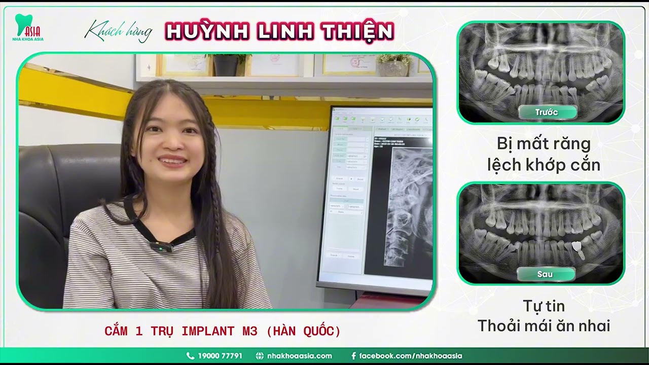 trồng răng implant toàn hàm