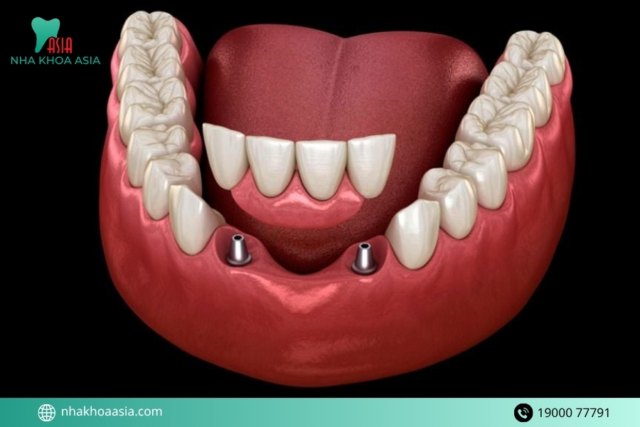 Có trồng răng sứ 2 răng cửa được không?