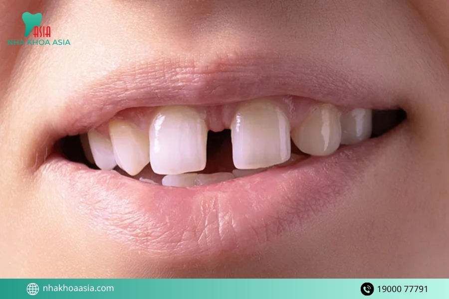 Quy trình trồng răng sứ 2 răng cửa chuẩn y khoa