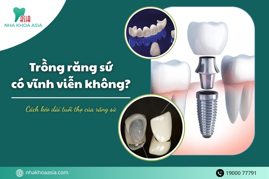 Trồng răng sứ có vĩnh viễn không? Cách kéo dài tuổi thọ của răng sứ