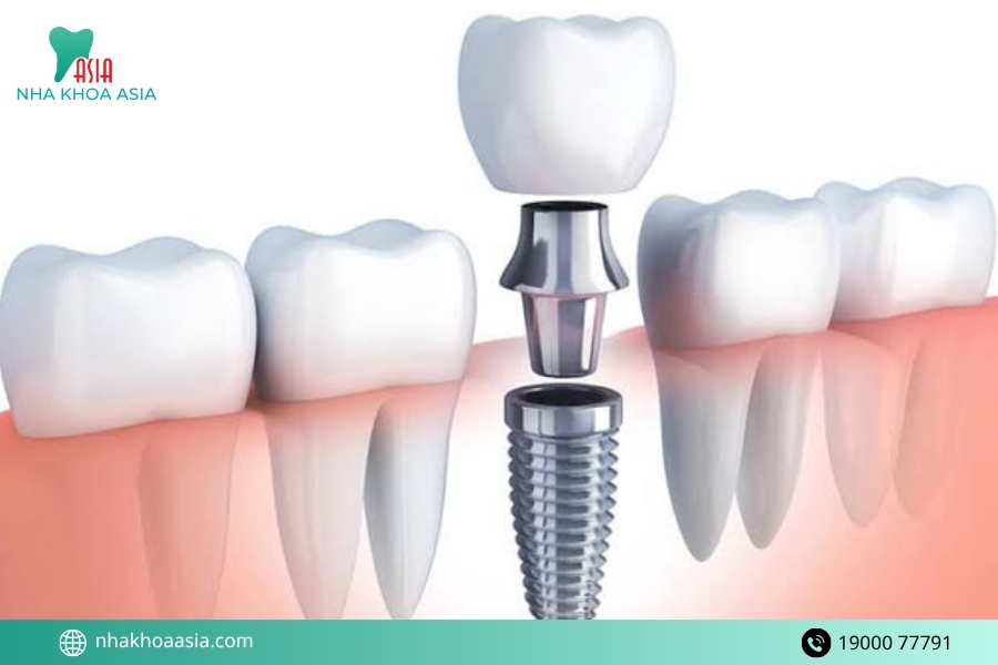 Trồng răng sứ có vĩnh viễn không?