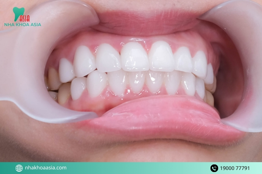 Chuyên gia mách bạn một số mẹo kéo dài tuổi thọ của răng sứ sau khi trồng