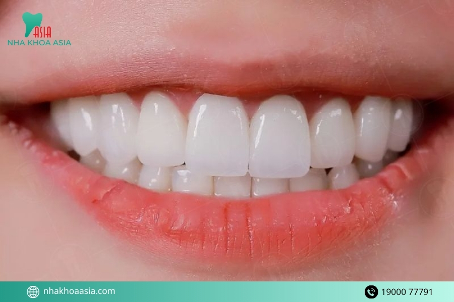 Những yếu tố ảnh hưởng đến độ bền của răng sứ sau khi trồng