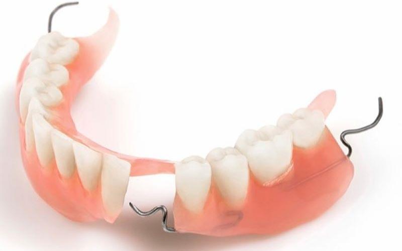 Phương pháp trồng răng sứ không có chân răng