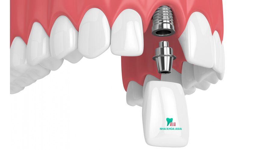 Trồng răng sứ implant
