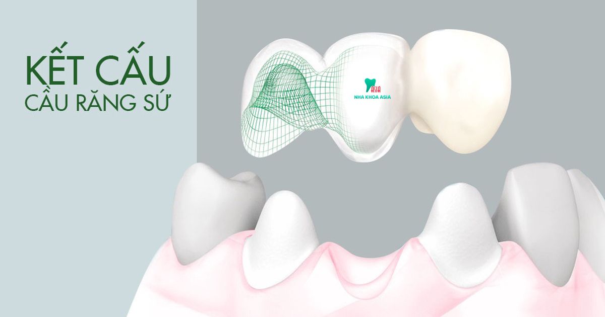 Cầu răng sứ