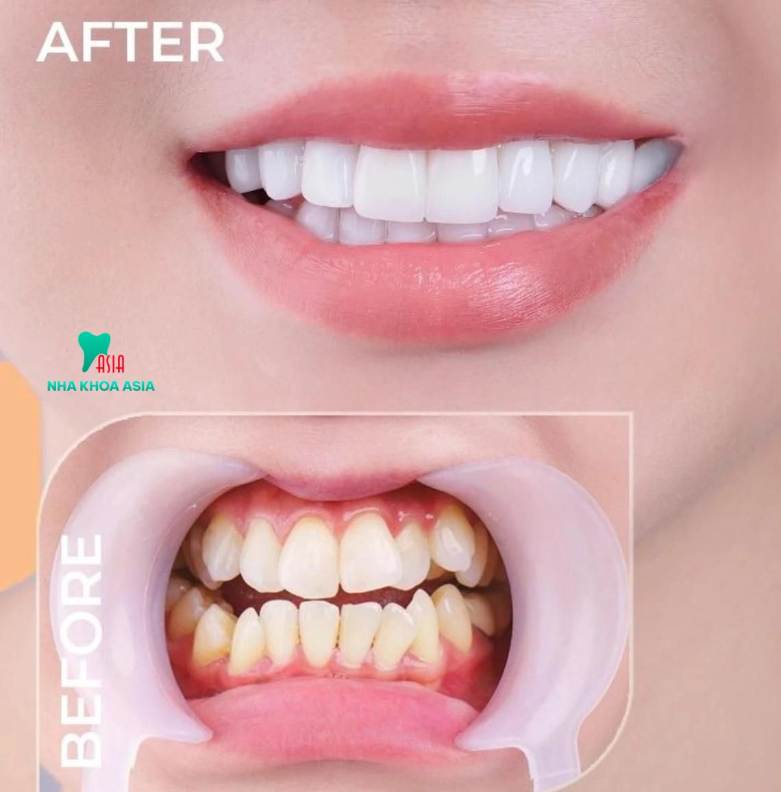 Các yếu tố ảnh hưởng đến chi phí trồng răng sứ vĩnh viễn