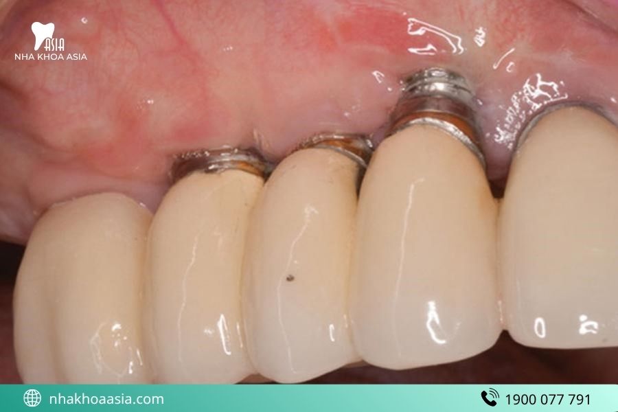 Trụ Implant bị đào thải