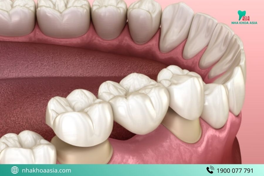 trường hợp nào không trồng được răng sứ cố định