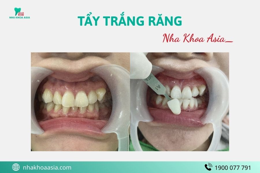 Những trường hợp không nên tẩy trắng răng