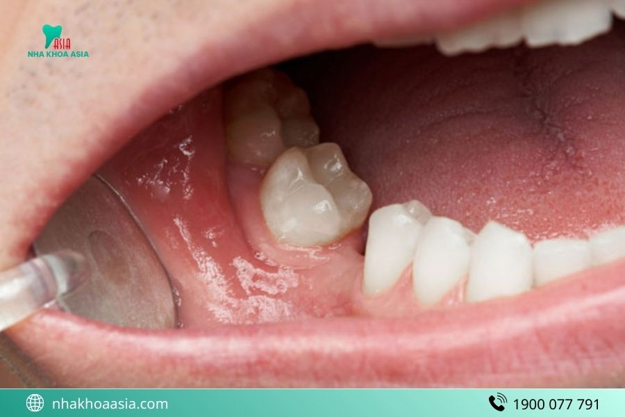 trường hợp trồng implant bị sưng đau 