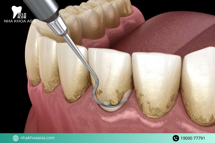 Cao răng là gì và vì sao cần lấy cao răng định kỳ?