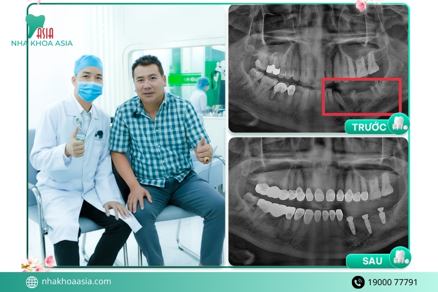 Vì sao nên chọn trồng răng implant tại nha khoa uy tín?