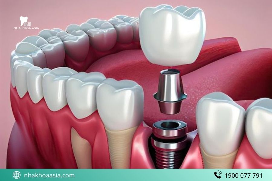 Vì sao nhiều người hối hận khi trồng Implant