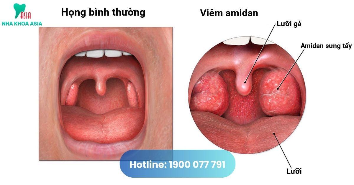 Amidan là gì? Viêm amidan là gì?