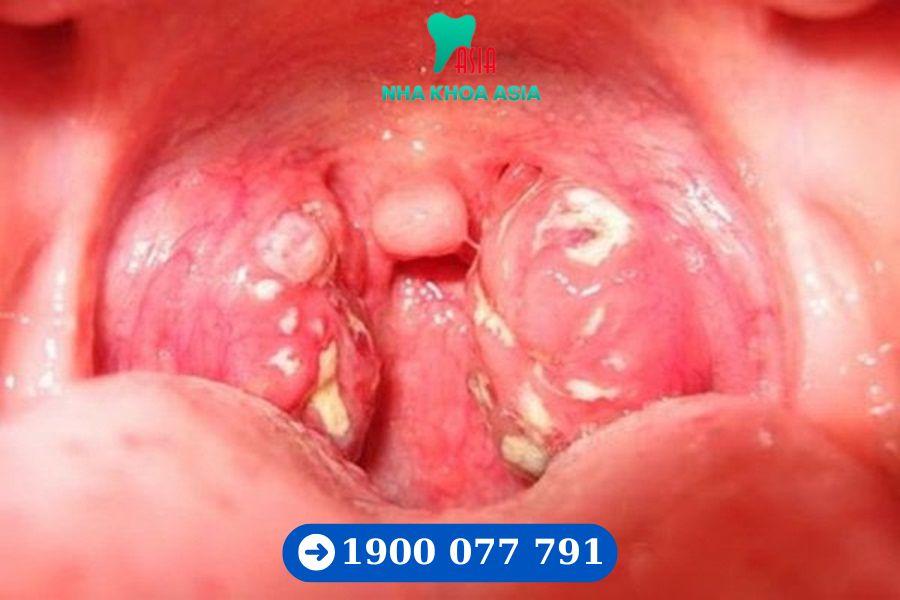 Các triệu chứng và dấu hiệu nhận biết khi bị viêm amidan 